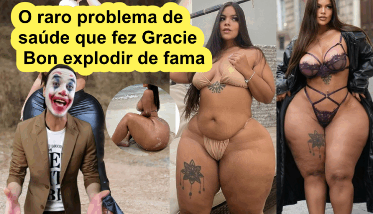 O raro problema de saúde que fez Gracie Bon explodir de fama